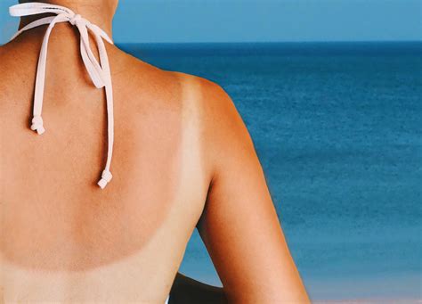 How to get rid of sunburn: What are the best…