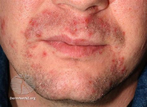 Prevent and Treat In-Grown Facial Hairs | ClinicalReads