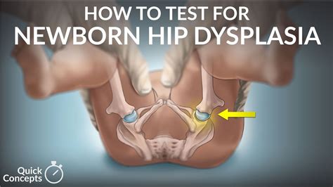 How to Test for Newborn Hip Dysplasia by N. Gold | OPENPediatrics - YouTube