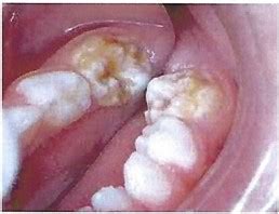 poor enamel on baby teeth - vanstaalspinningreel