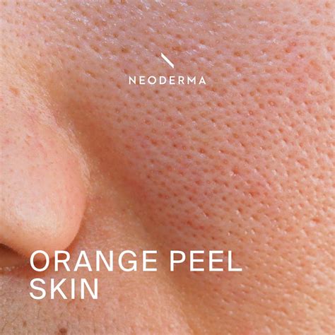 Orange Peel Skincare Routine | NEODERMA