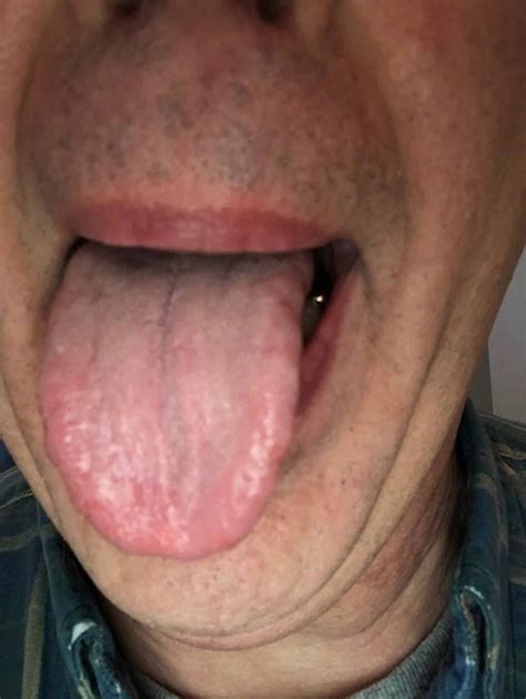 Cureus | Oral Psoriasis of the Tongue: A Case Report