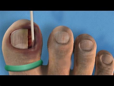 Ingrown Toenail Surgery - YouTube