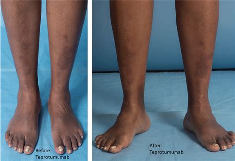 Showing pretibial myxedema before and after teprotumumab. | Download ...