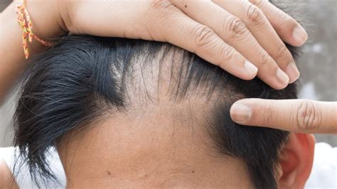 Receding Hairline Meaning, Types, Causes, Regrowth Treatments and Remedies - American Celiac