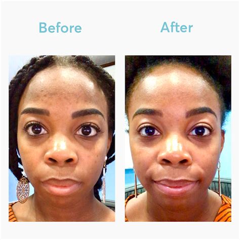 Dark Spot Remover | MDacne | Hyperpigmentation treatment, Hyperpigmentation black skin, Remove ...