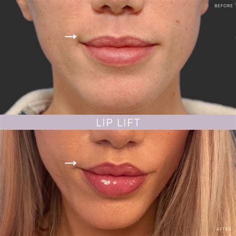 Lip Lift NYC | Lip Specialist New York