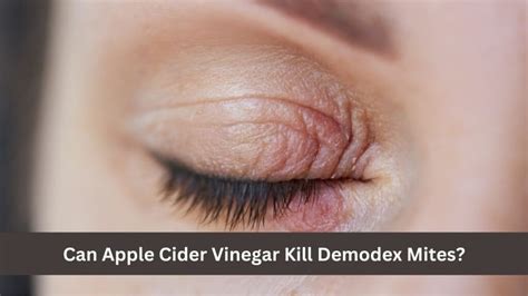 Does Apple Cider Vinegar Kill Demodex Mites on Humans?