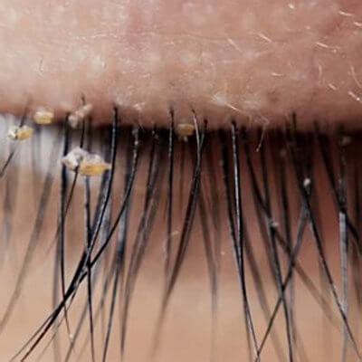 People Are Getting Lash Lice From Eyelash Extensions, Doctors Say