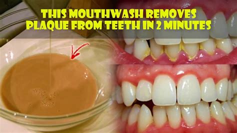 This Mouthwash Removes Plaque From Teeth In 2 Minutes - clickbank ...