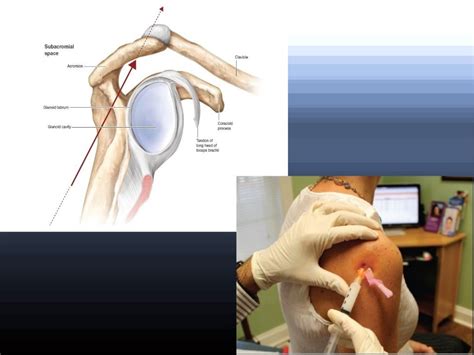 Corticosteroid injections in Orthopaedics