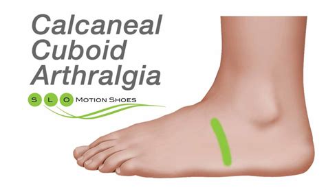 Calcaneocuboid Joint Pain - SLO Motion ShoesSLO Motion Shoes