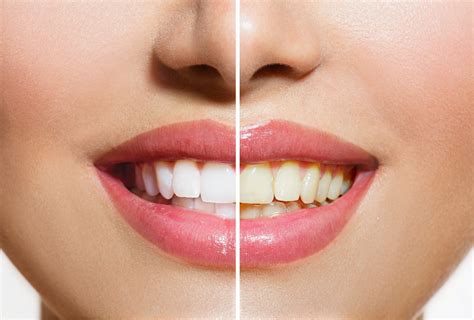 10 Facts About Healthy Teeth Whitening You Need to Know