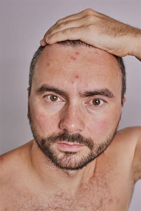 Man with Acne, Red Spots, Skin Disease Looks in the Mirror Stock Photo ...