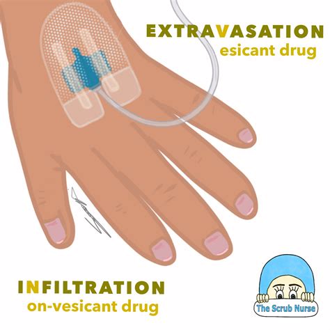 How to tell the difference between Extravasation and Infiltration ...