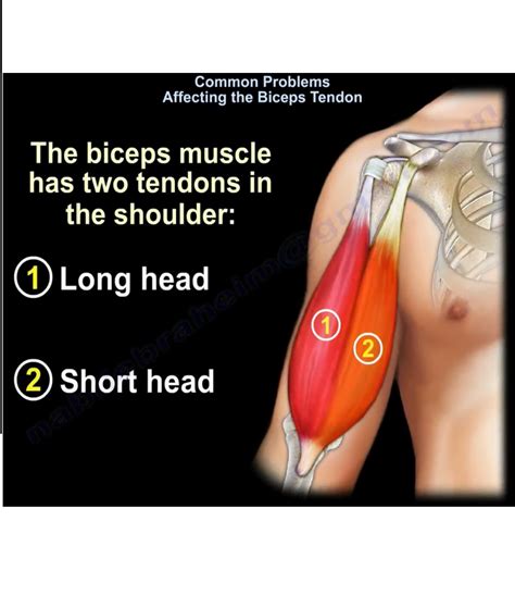 Biceps tendon Pathologies — OrthopaedicPrinciples.com