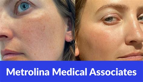 Vascular Laser Treatment for Acne Scars | Metrolina Medical Associates