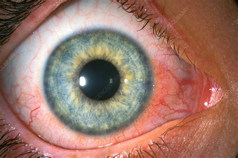 Phlyctenular keratoconjunctivitis - Stock Image - C034/5808 - Science ...