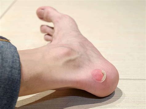 Lateral Midfoot Styloid Process Blisters Blister Prevention, 52% OFF