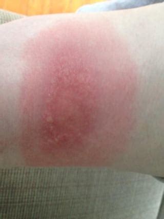 Tick Bite - Lyme Rash Progression : r/medizzy