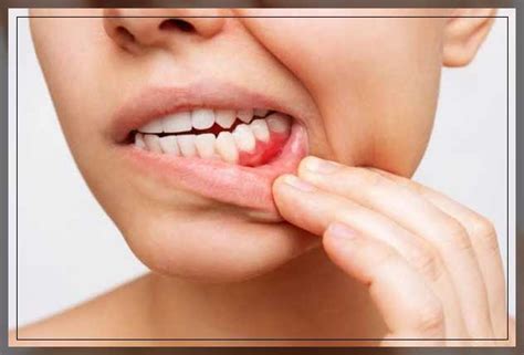 Itchy Gums: Causes, Relief, and Prevention - Dentist Ahmed