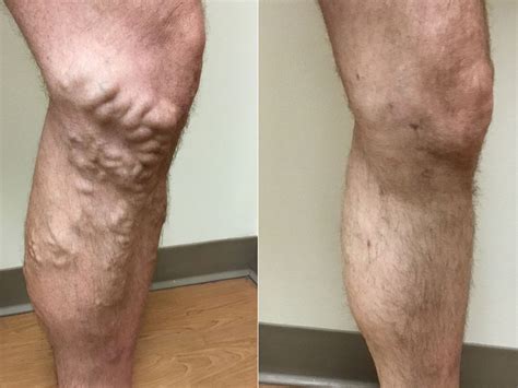 Do Men Get Varicose Veins? - Denver Vein Center