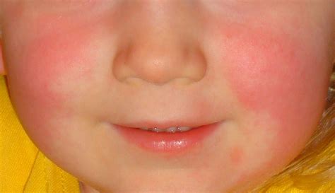 Numbered Rash Diseases of Childhood: SECOND disease - Scarlet Fever