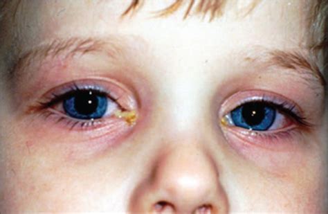 6 Things to Know About Conjunctivitis in Children (pink eye) – Things Parenting