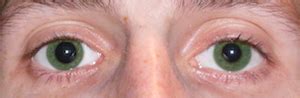 Anisocoria: Definition, Causes & Symptoms | Study.com