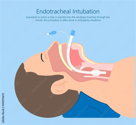 Endotracheal intubation ICU care unit COVID 19 larynx throat rescue surgery mouth Tube trachea ...