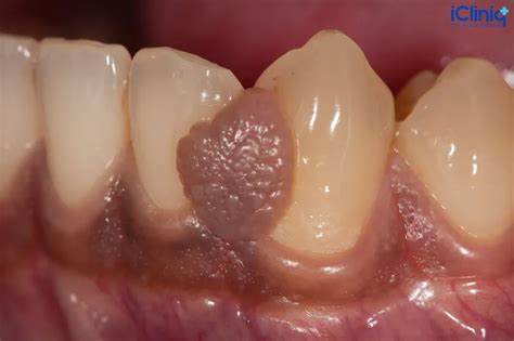 Oral Fibroma | Causes | Symptoms | Diagnosis | Treatment