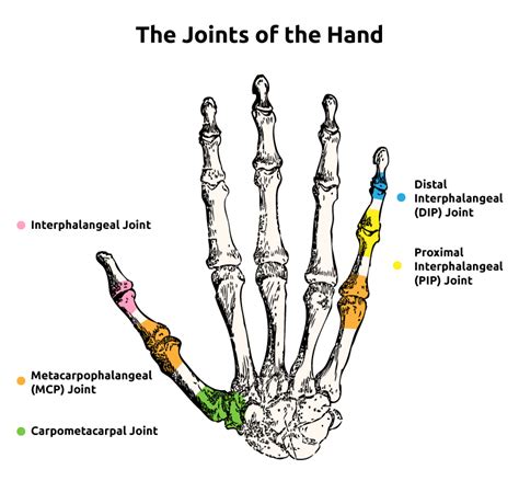 What Is MCP Joint Arthritis? - WristSupports.co.uk