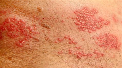 How to treat Groin Rashes: The rash is known to often affect areas of the...