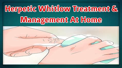 Herpetic Whitlow Treatment & Management At Home - YouTube