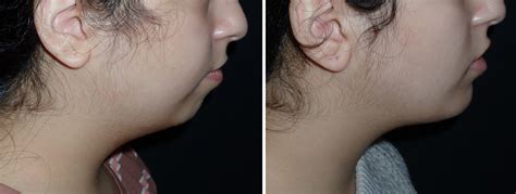 Submentoplasty Richmond VA | Chin & Neck Lift | Neck Rejuvenation