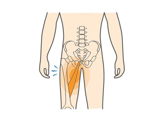 What is a Groin Pull & How to Recover from Such Strain? - Upswing Health