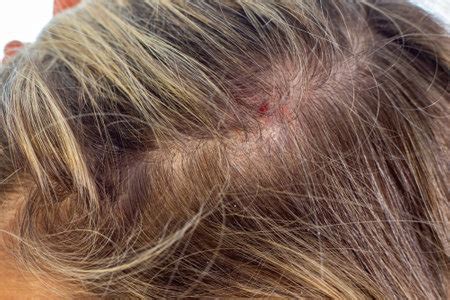 Recurring Scab On Scalp In The Same Spot: Causes, Prevention, Treatment