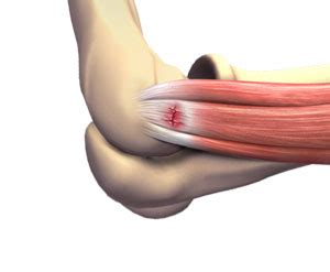 Tennis Elbow Surgery | Advanced Orthopaedics & Sports Medicine, Orthopaedic Specialists, Cypress ...