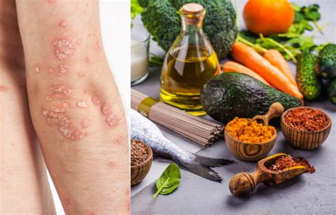 Psoriasis diet: food to eat and avoid, and Indian diet plan