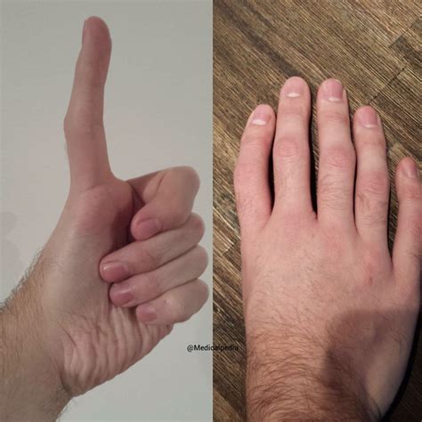 An interesting case of triphalangeal thumb - MEDizzy Journal