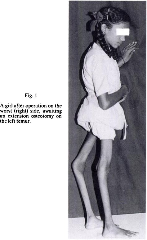 Figure 1 from FLEXION OSTEOTOMY OF THE FEMUR FOR GENU RECURVATUM | Semantic Scholar