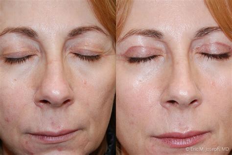 Eric M. Joseph, MD | Eyelid Surgery Before & After Photos