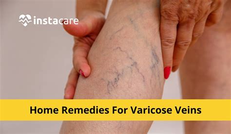 12 Effective Home Remedies For Varicose Veins