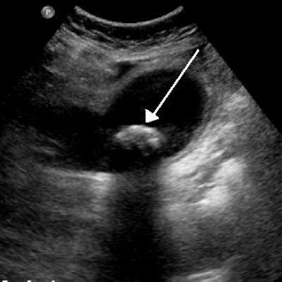 Surgical follow-up after ED cholelithiasis episode cuts long-term costs, complications | MDedge ...