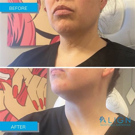 Before and After Non-Surgical Neck Treatment | Align Injectable Aesthetics