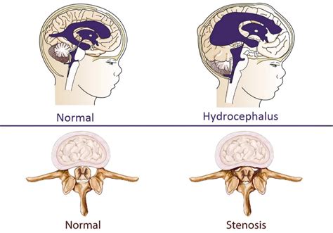 Achondroplasia | Causes, Signs, Standard Therapies, Prevention in children & More - Page 3 of 16 ...