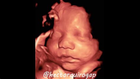 3D Ultrasound Scan of a Baby Boy at 31 Weeks with gender reveal - YouTube