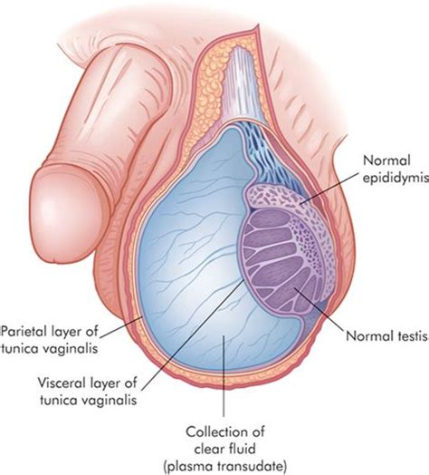 Hydrocele | Men health tips, Men’s health, Mens health