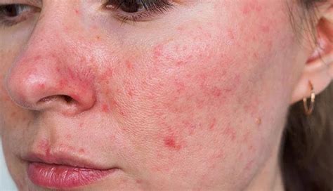 8 Effective Home Remedies to Alleviate Rosacea Symptoms - lifeberrys.com