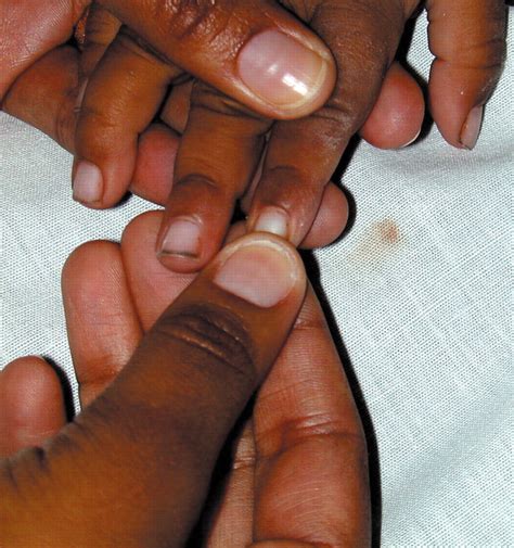 Capillary refill: prognostic value in Kenyan children | Archives of Disease in Childhood